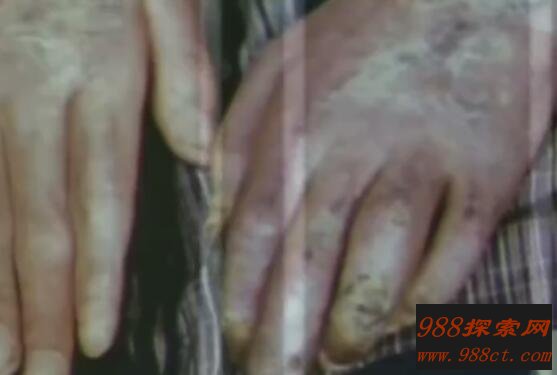 日本核辐射下的变异人